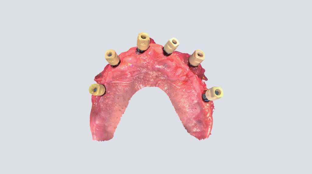 All-on-6Implant.jpg All-on-6Implant.jpg